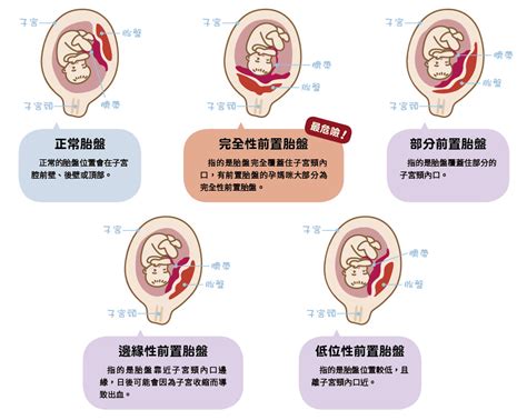 前置胎盤剝離|胎盤早剝(胎盤早期剝離):病因,臨床表現,檢查,診斷,鑑別診斷,治療,。